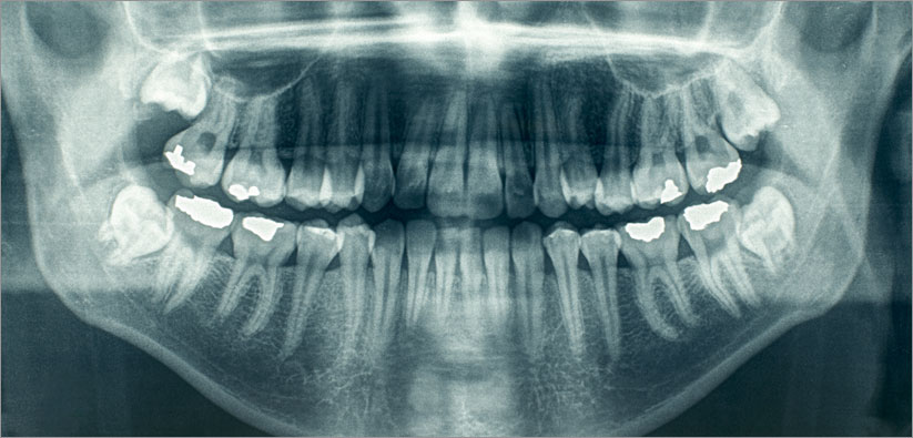 Dental Xrays